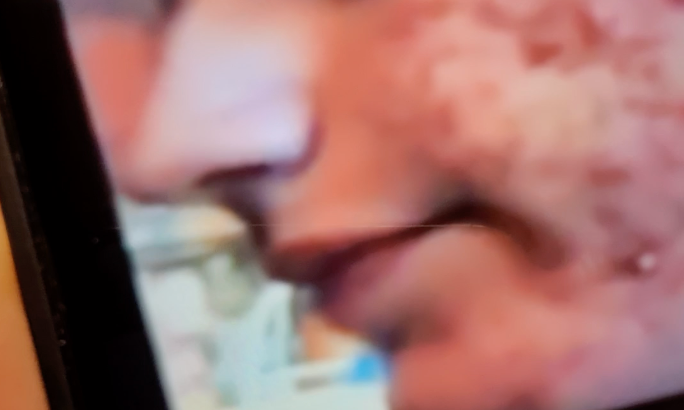 Acne 101 - What is Acne? PLUS my tips to help heal it