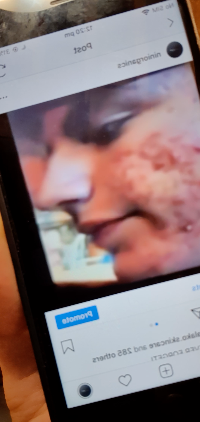 Acne 101 - What is Acne? PLUS my tips to help heal it